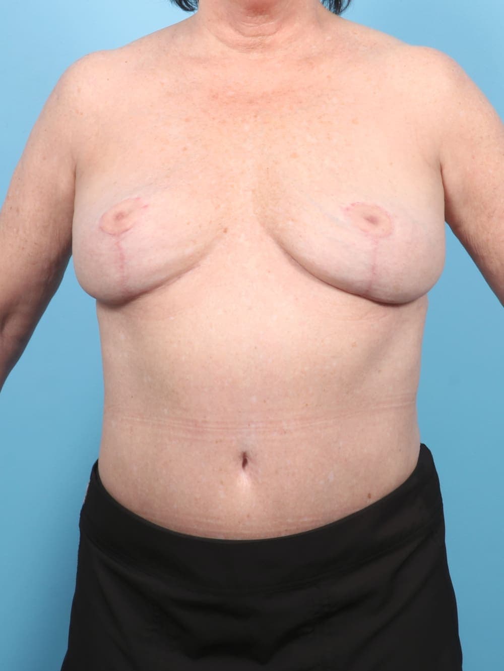 Breast Implant Removal with Lift case #6785 after, image 1