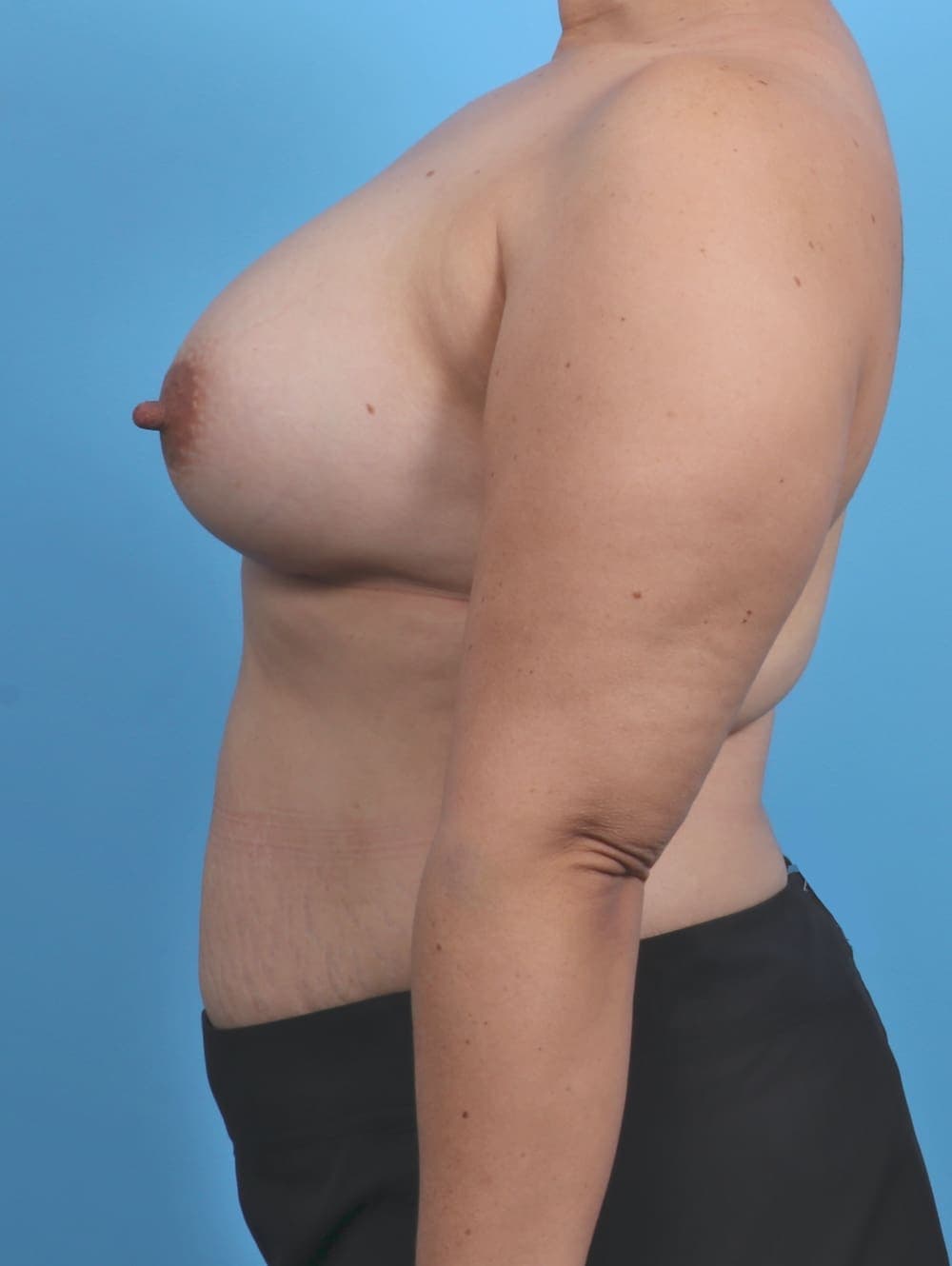Breast Lift with Implants case #4347 after, image 3