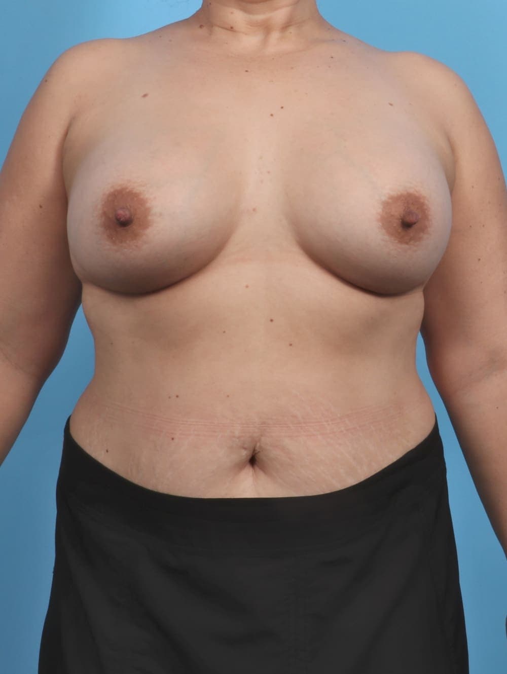 Breast Lift with Implants case #4347 after