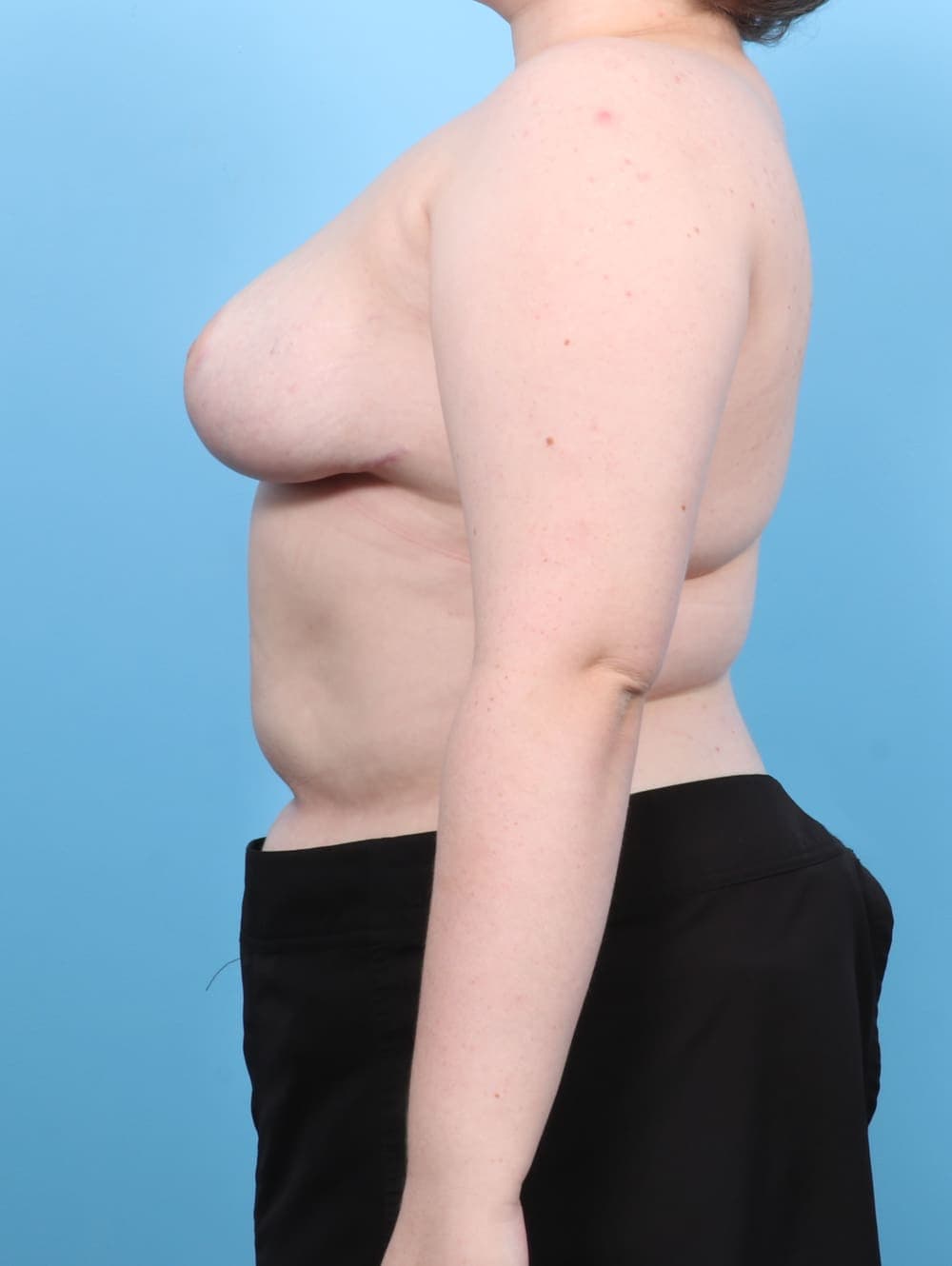 Breast Lift/Reduction case #6949 after, image 3