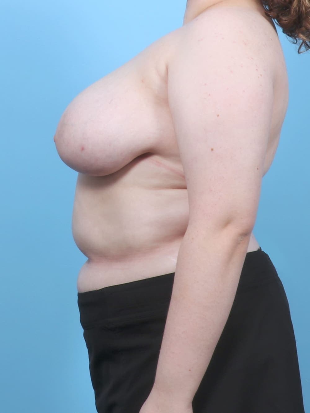 Breast Lift/Reduction case #6949 before, image 3