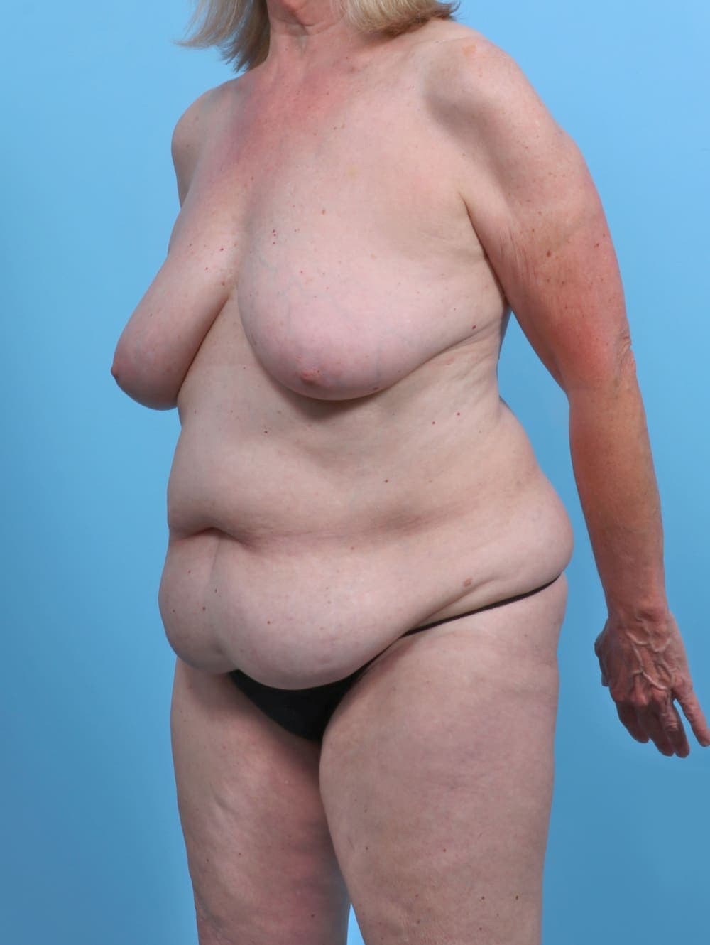 Mommy Makeover case #4972 before, image 2