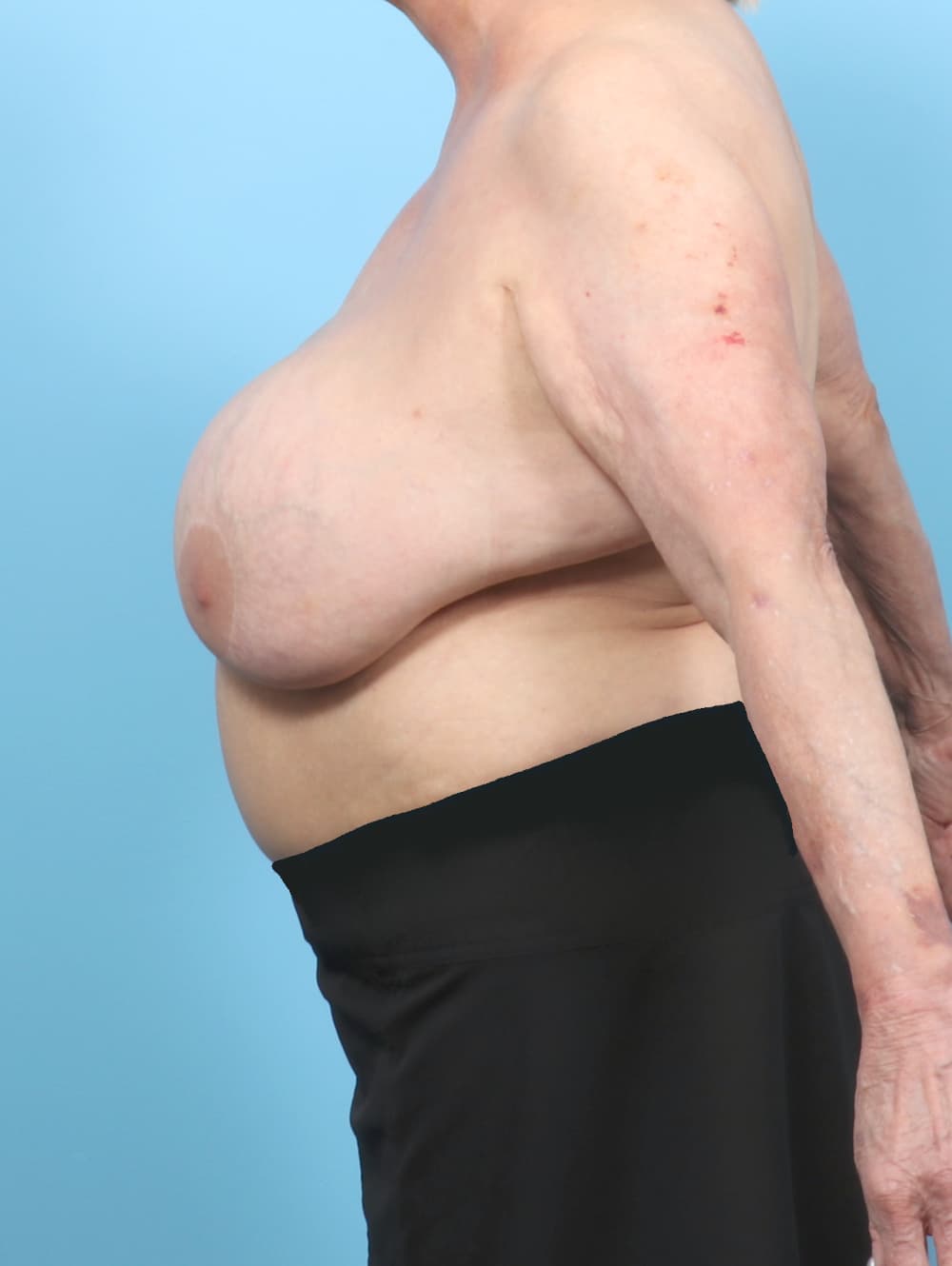 Breast Implant Removal with Lift case #7952 before, image 3