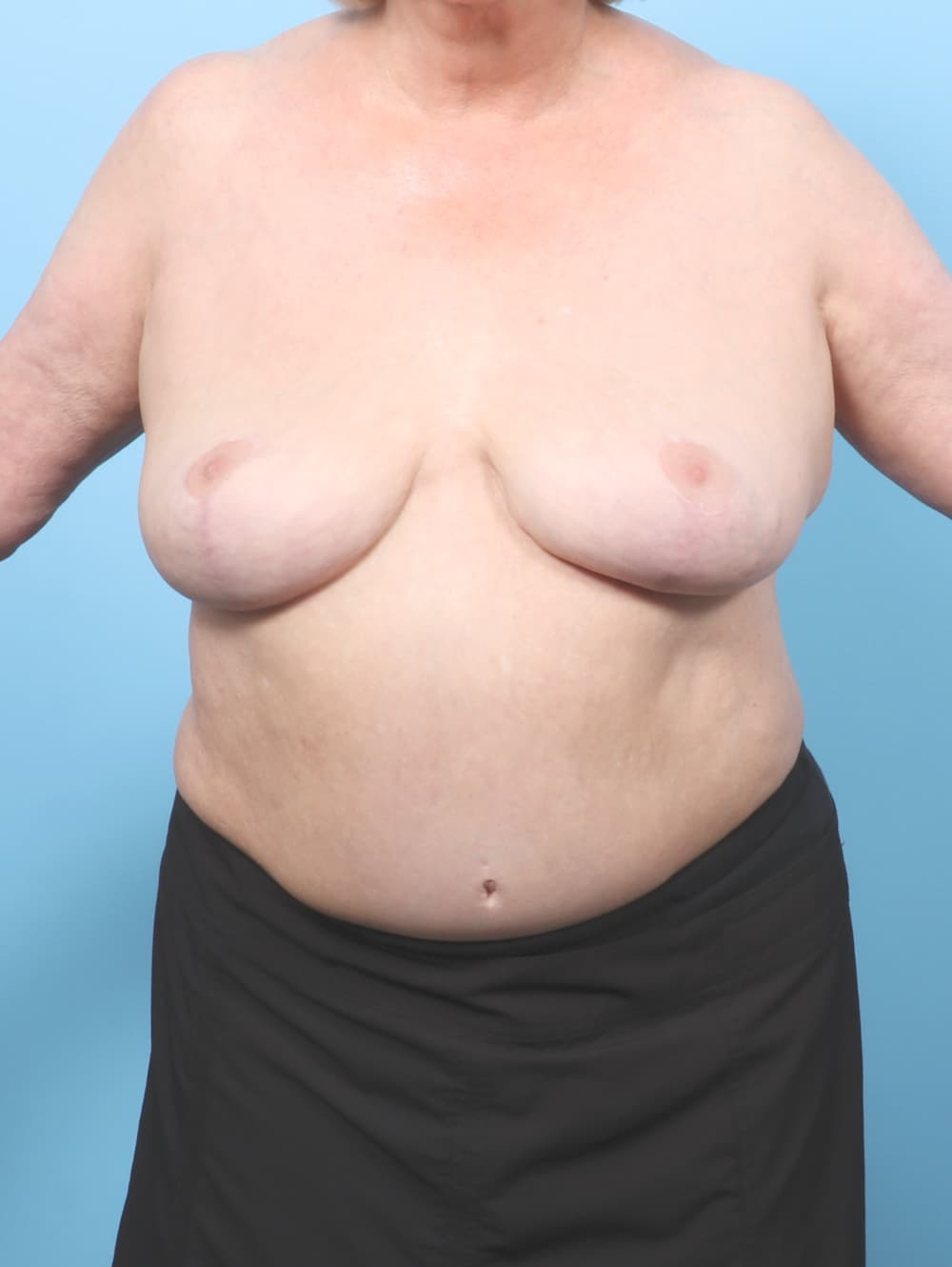 Breast Implant Removal with Lift case #7952 after, image 1