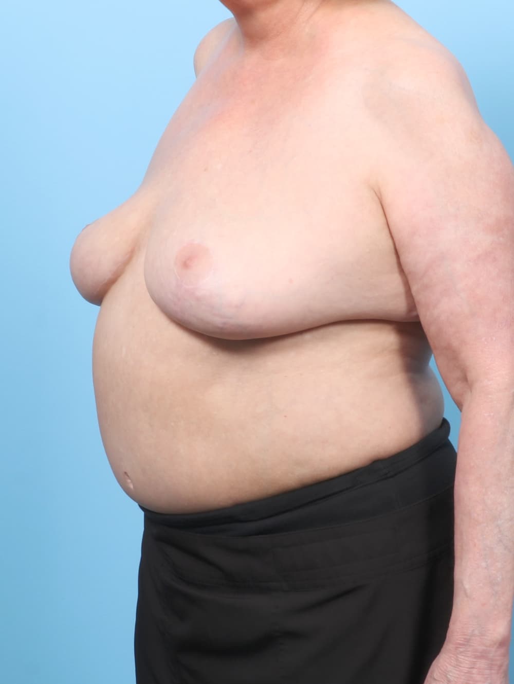 Breast Implant Removal with Lift case #7952 after, image 2