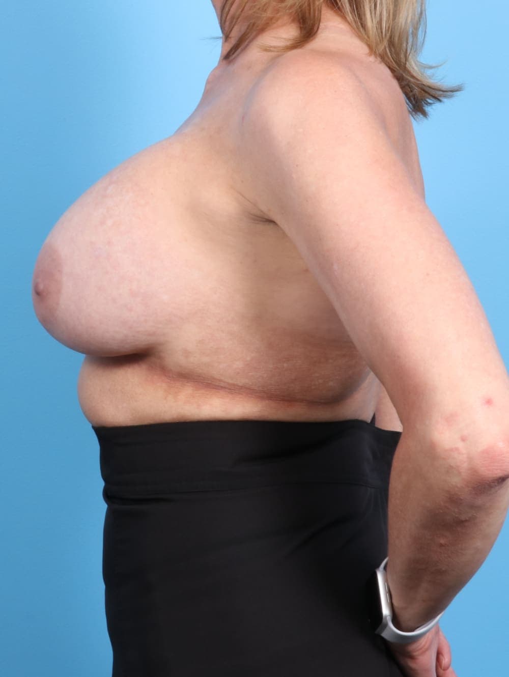 Breast Implant Removal with Lift case #1949 before, image 3