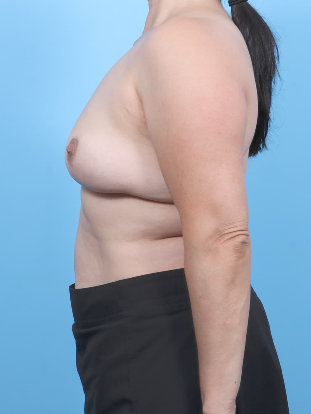 Breast Implant Removal with Lift case #7130 after, image 3