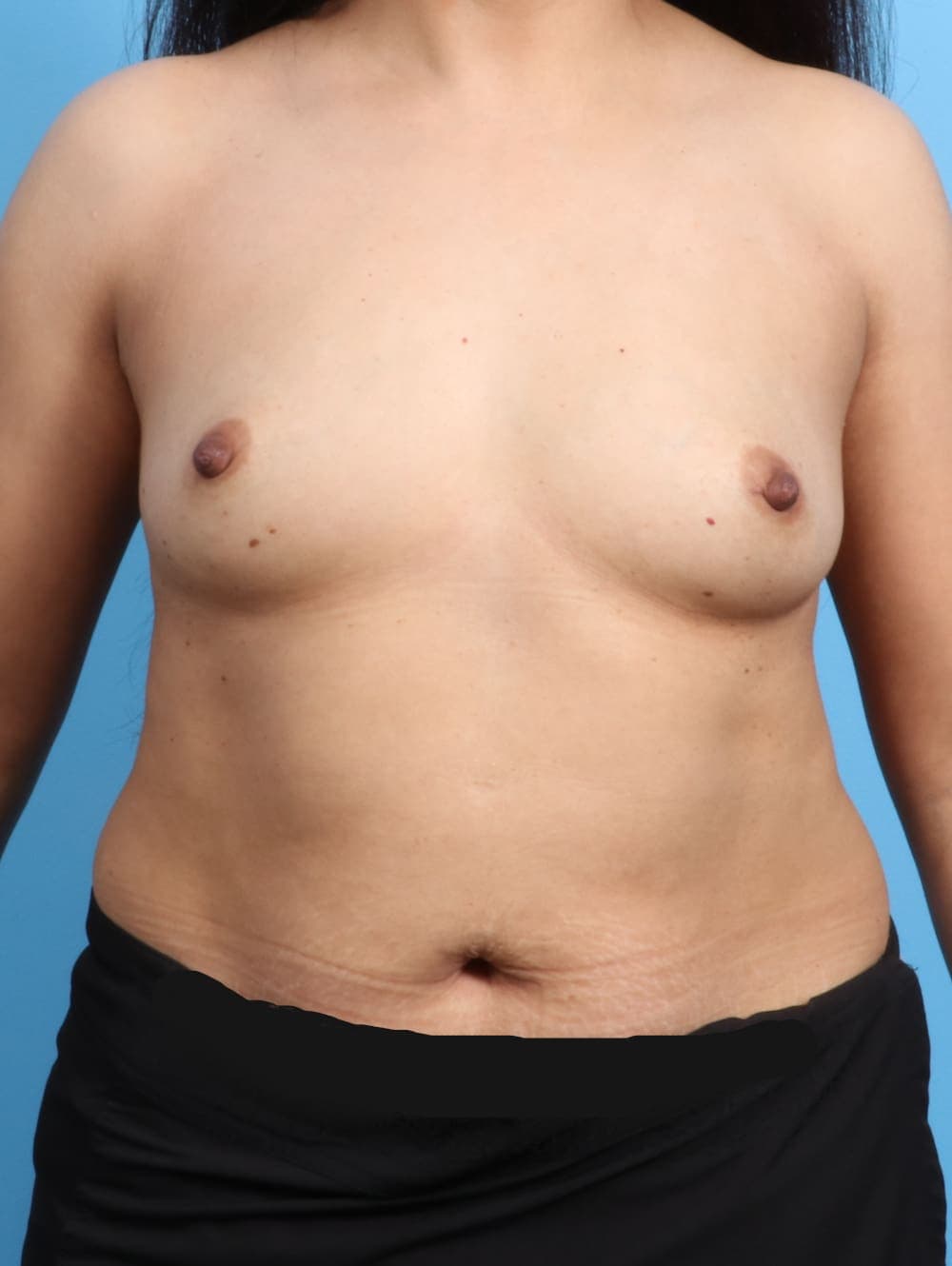 Breast Augmentation case #2436 before