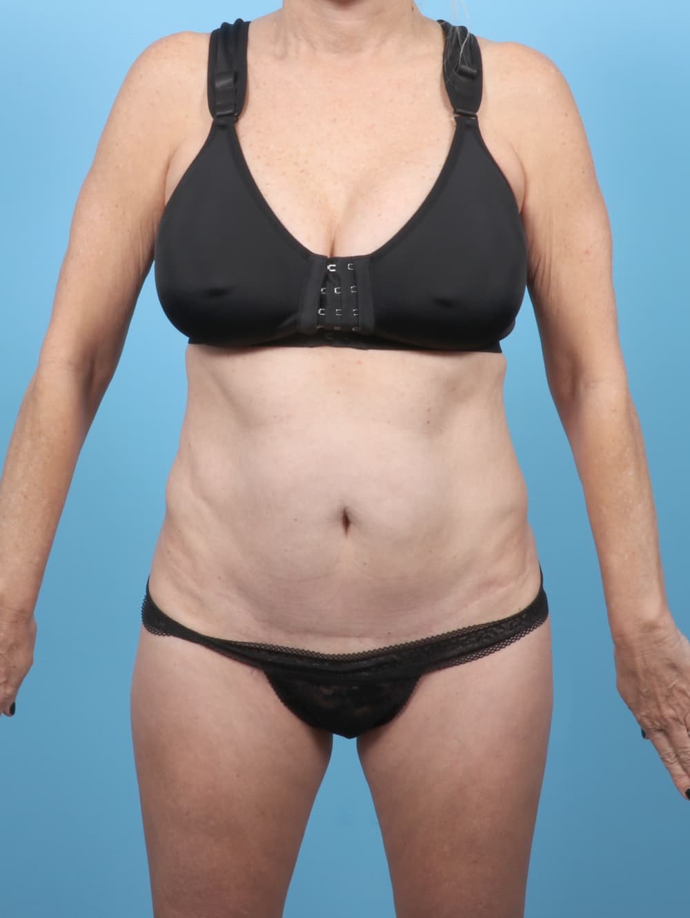 Tummy Tuck case #7088 before