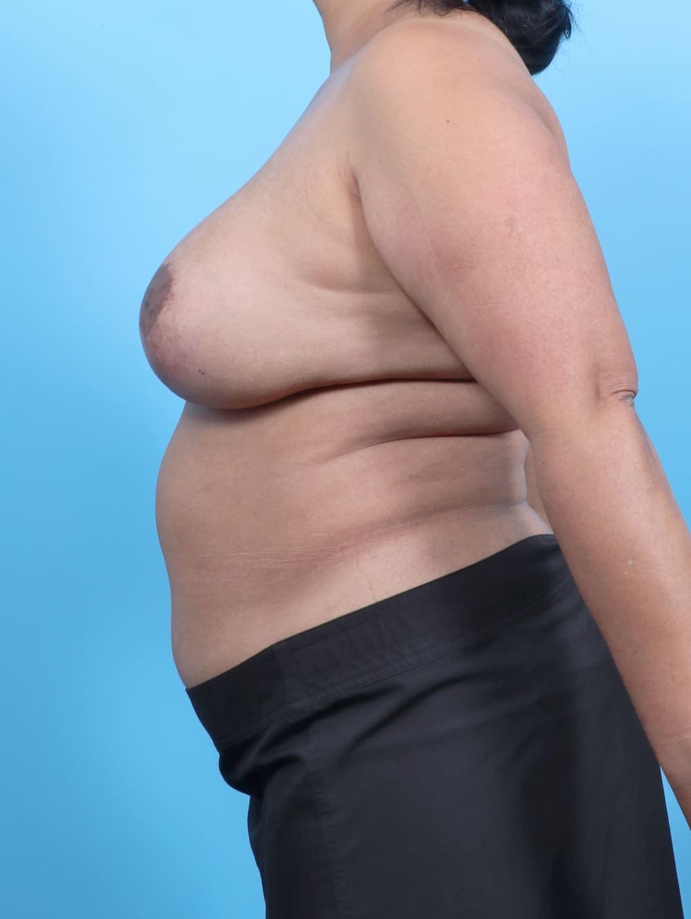 Breast Implant Revision case #6221 before, image 3