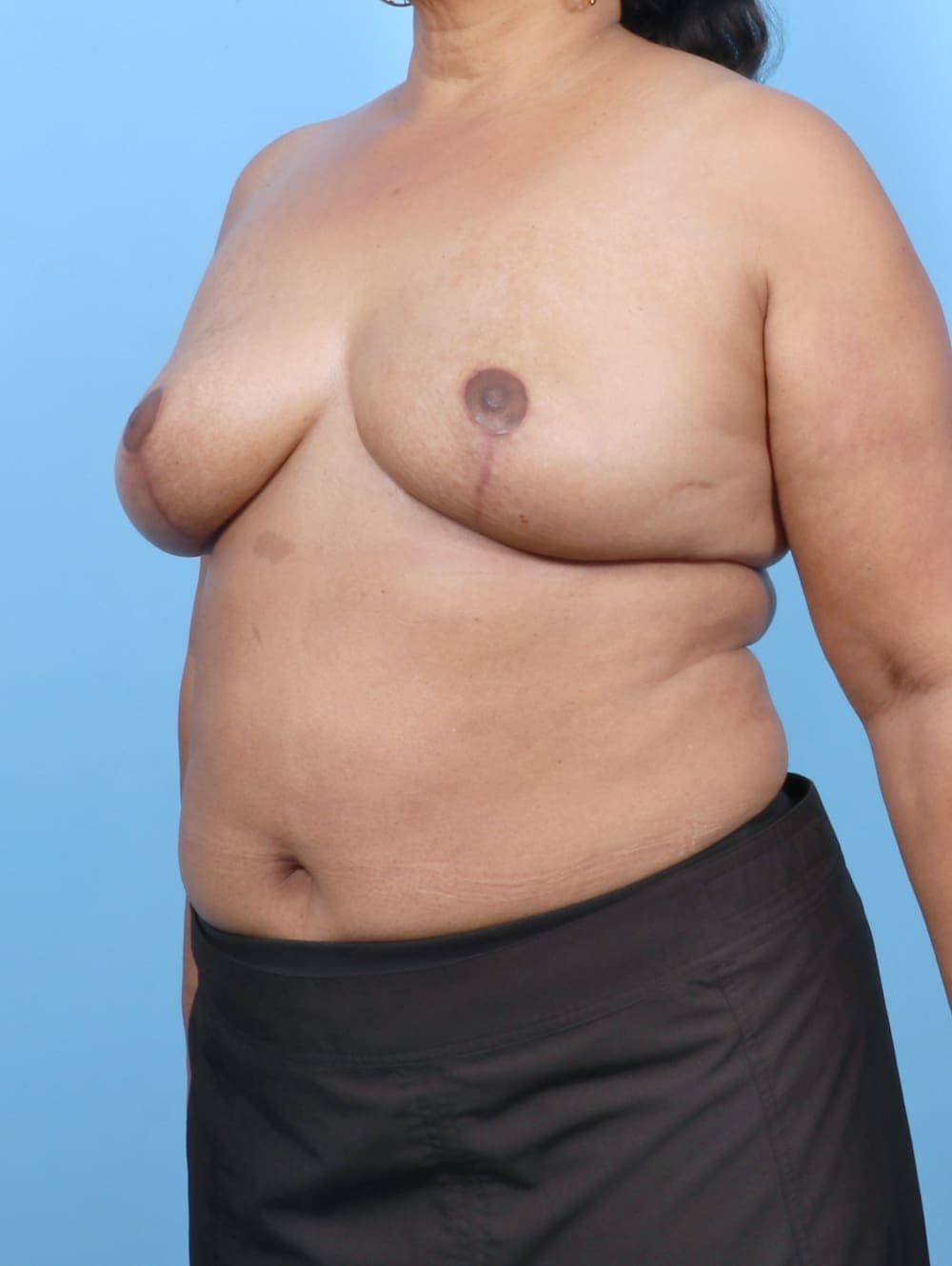 Breast Implant Revision case #6221 after, image 2