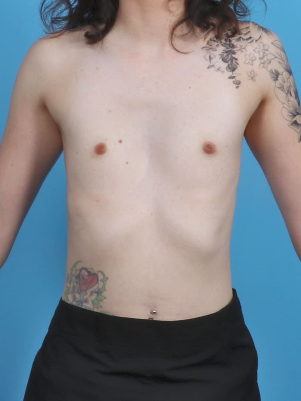 Breast Augmentation case #4818 before