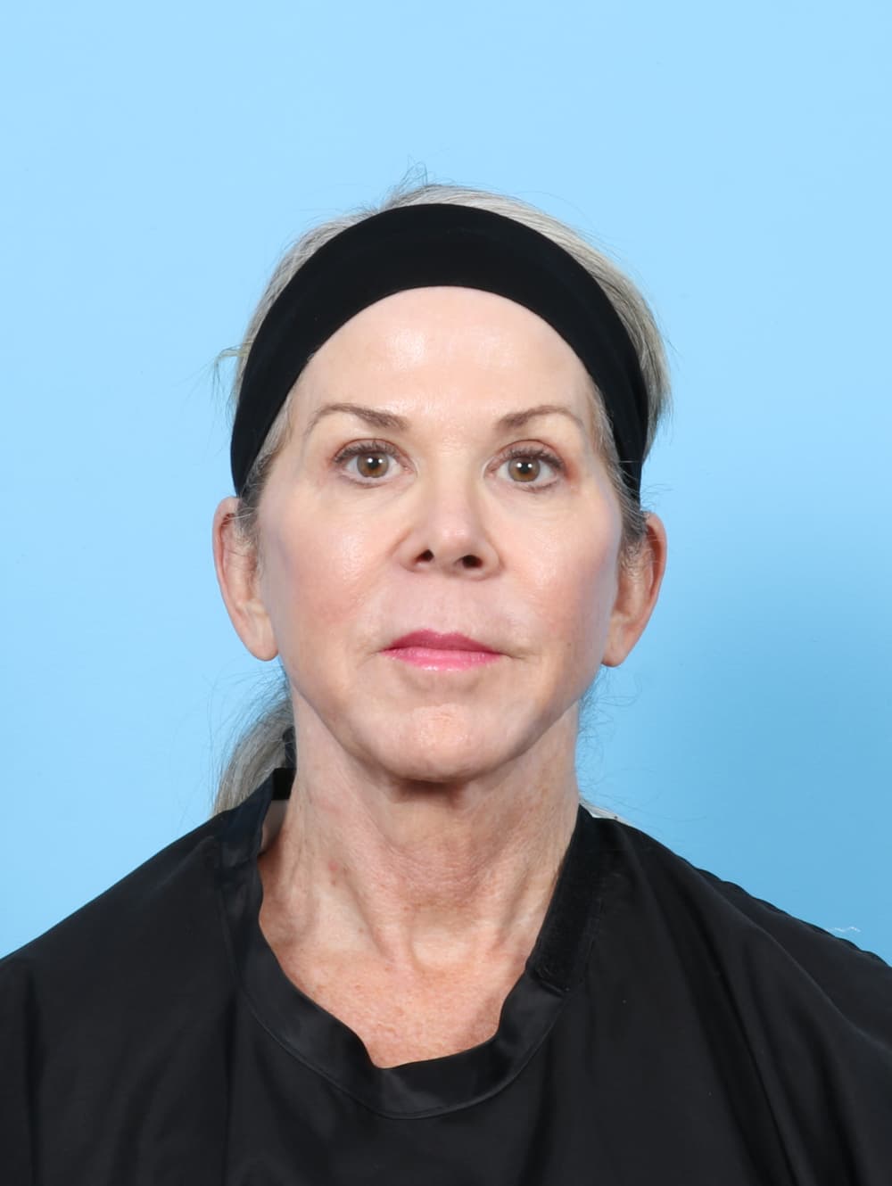 Facial Surgery case #7382 after