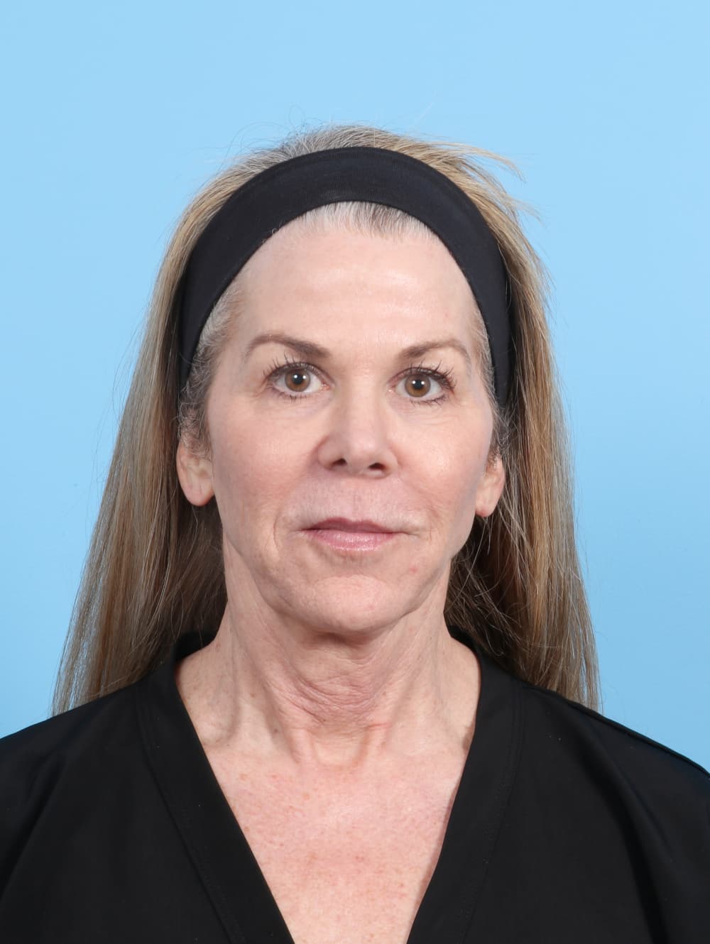 Facial Surgery case #7382 before