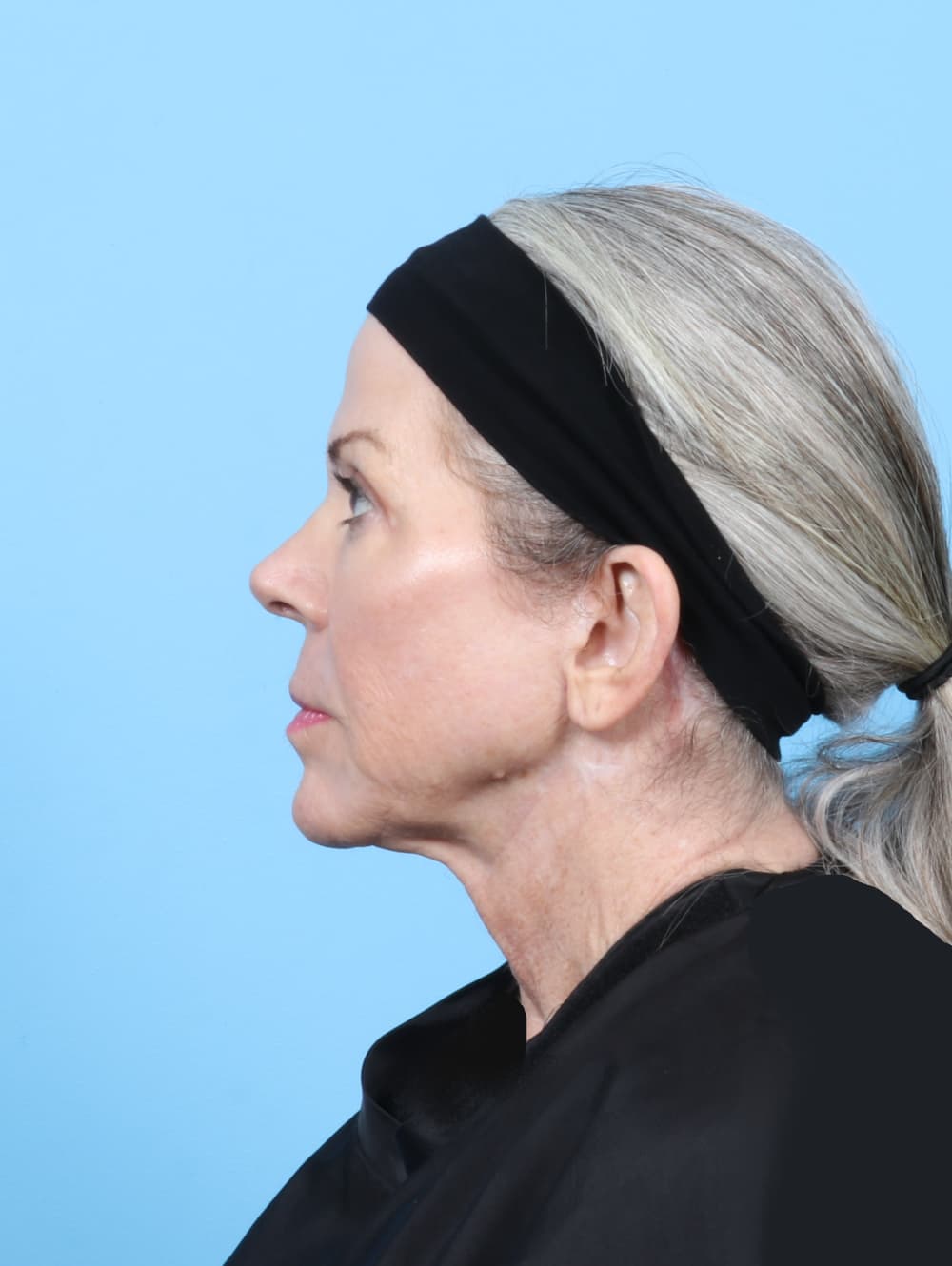 Facelift case #7382 after, image 3
