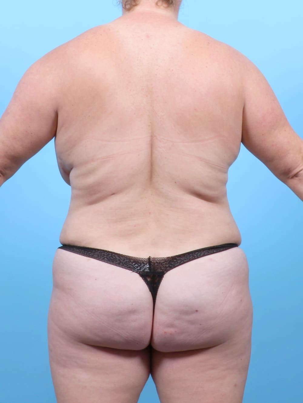 Breast Lift with Implants case #6479 after, image 2