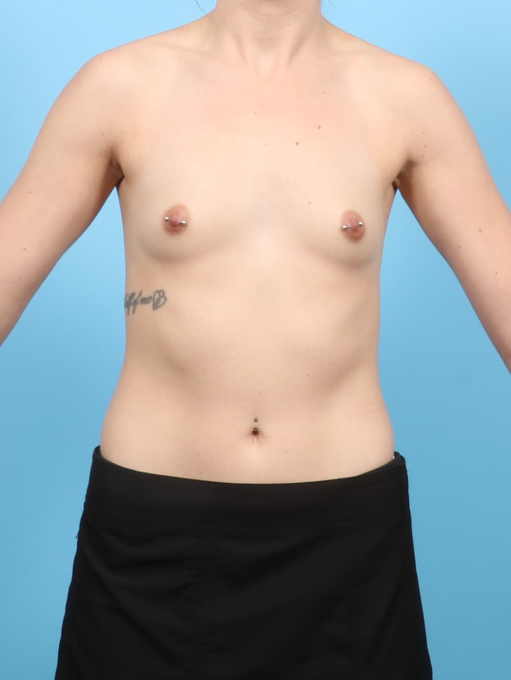 Breast Augmentation case #7734 before