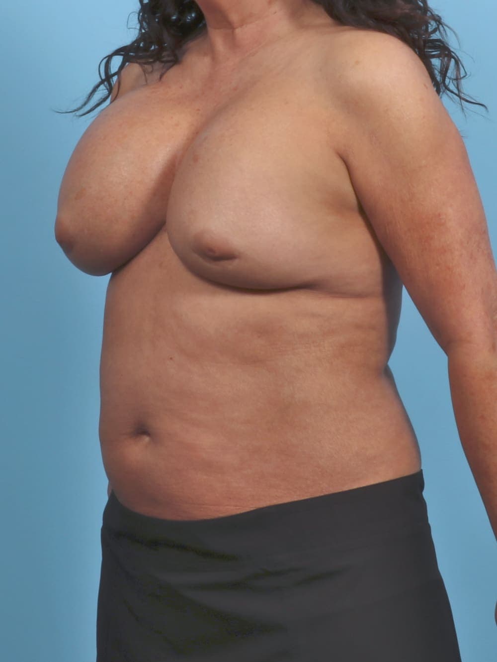 Breast Implant Revision case #5359 before, image 2