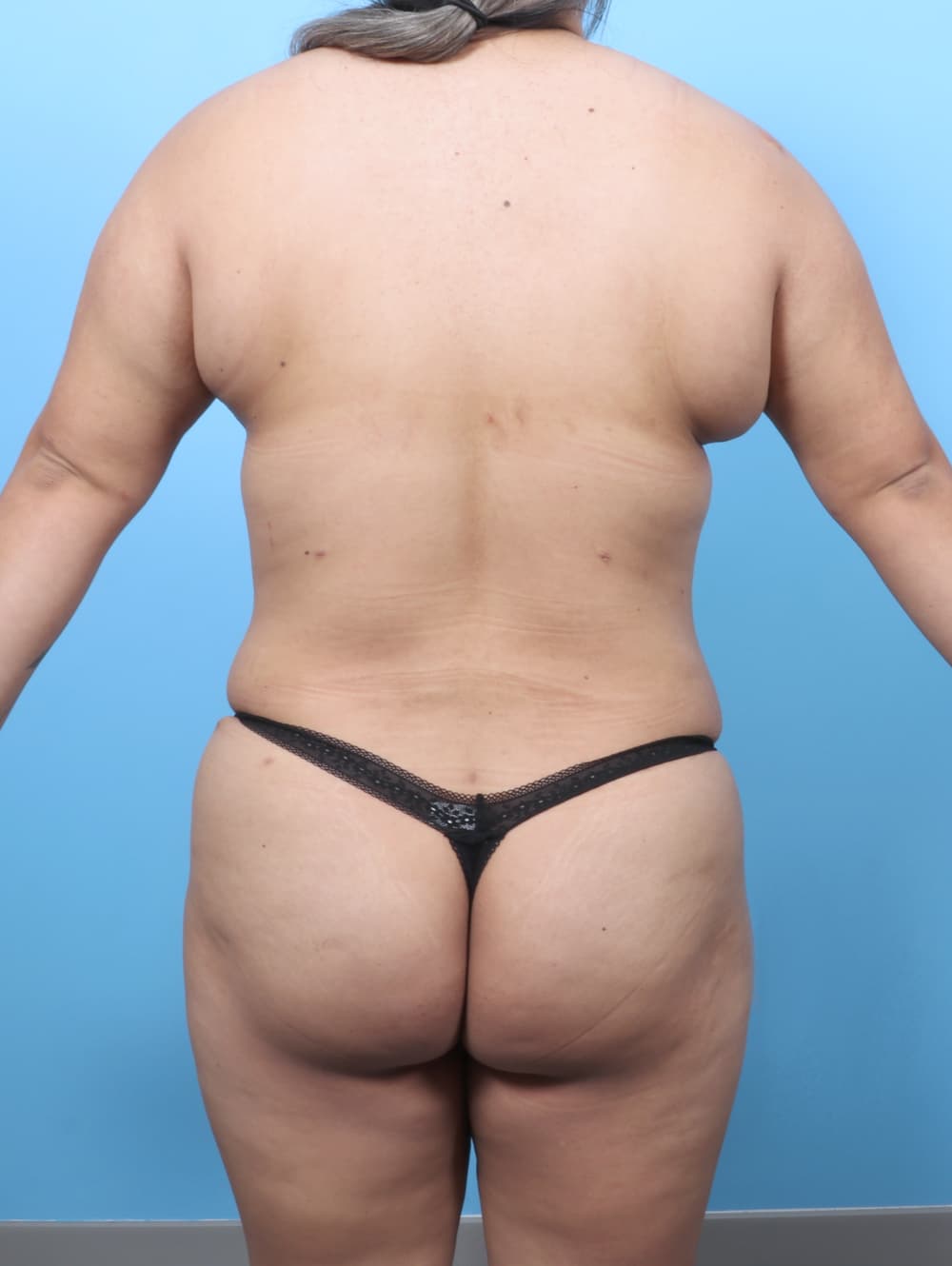 Tummy Tuck case #8738 after, image 4