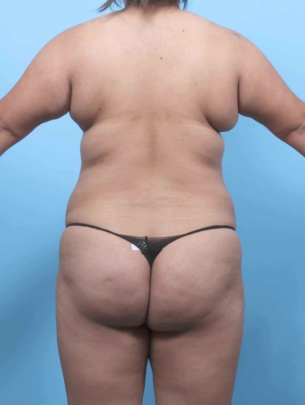 Tummy Tuck case #8738 before, image 4