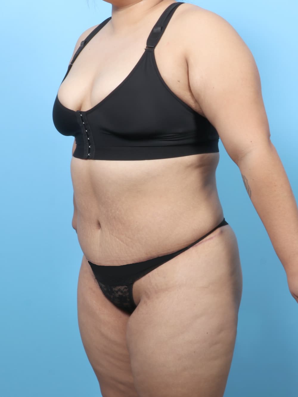 Tummy Tuck case #8738 after, image 2