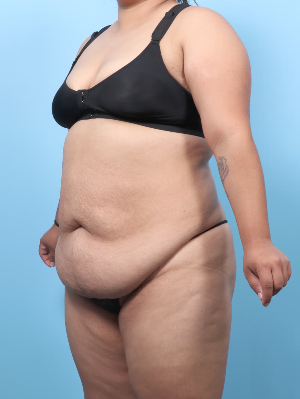 Tummy Tuck case #8738 before, image 2