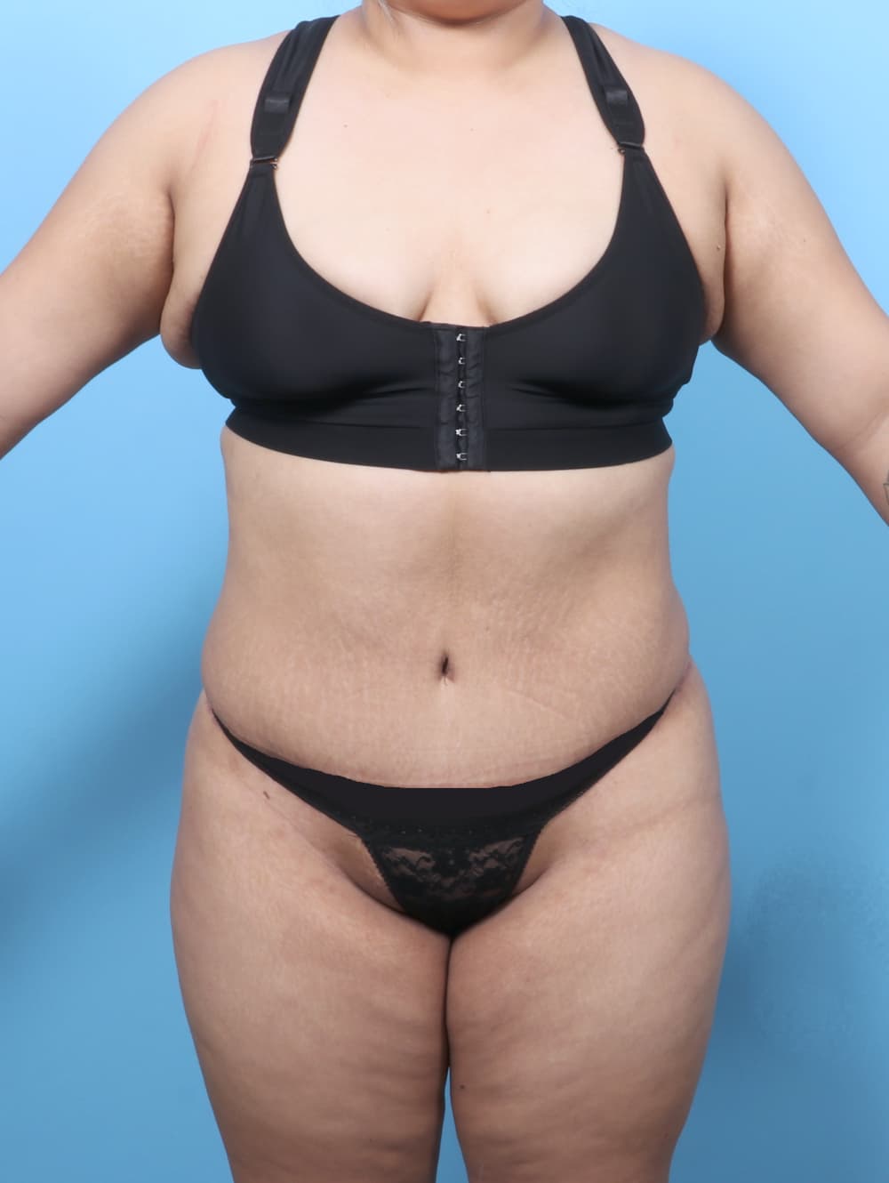 Tummy Tuck case #8738 after, image 1