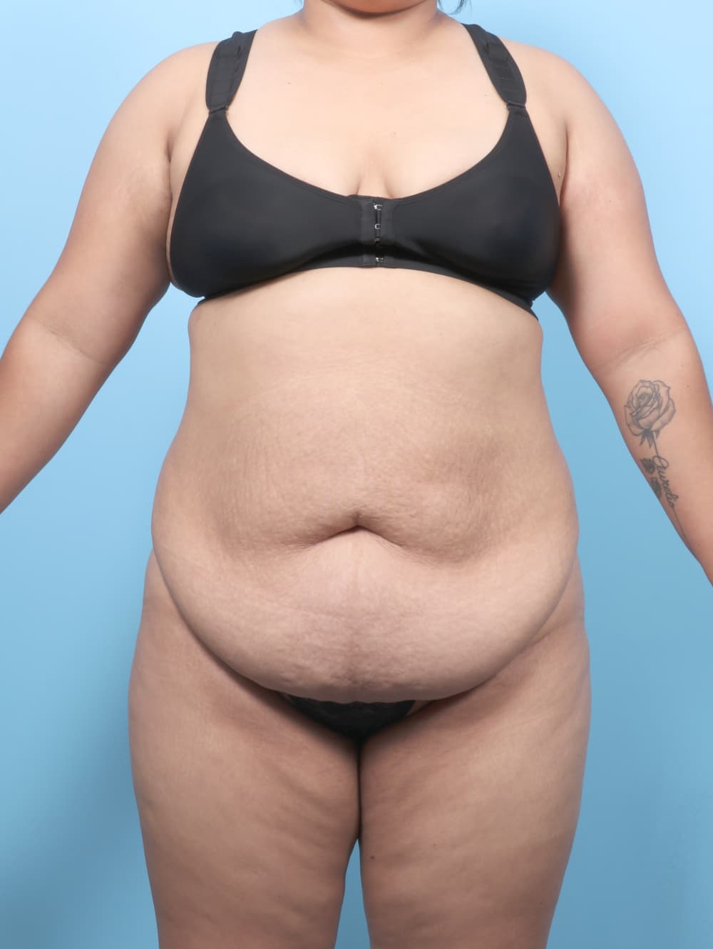 Tummy Tuck case #8738 before, image 1