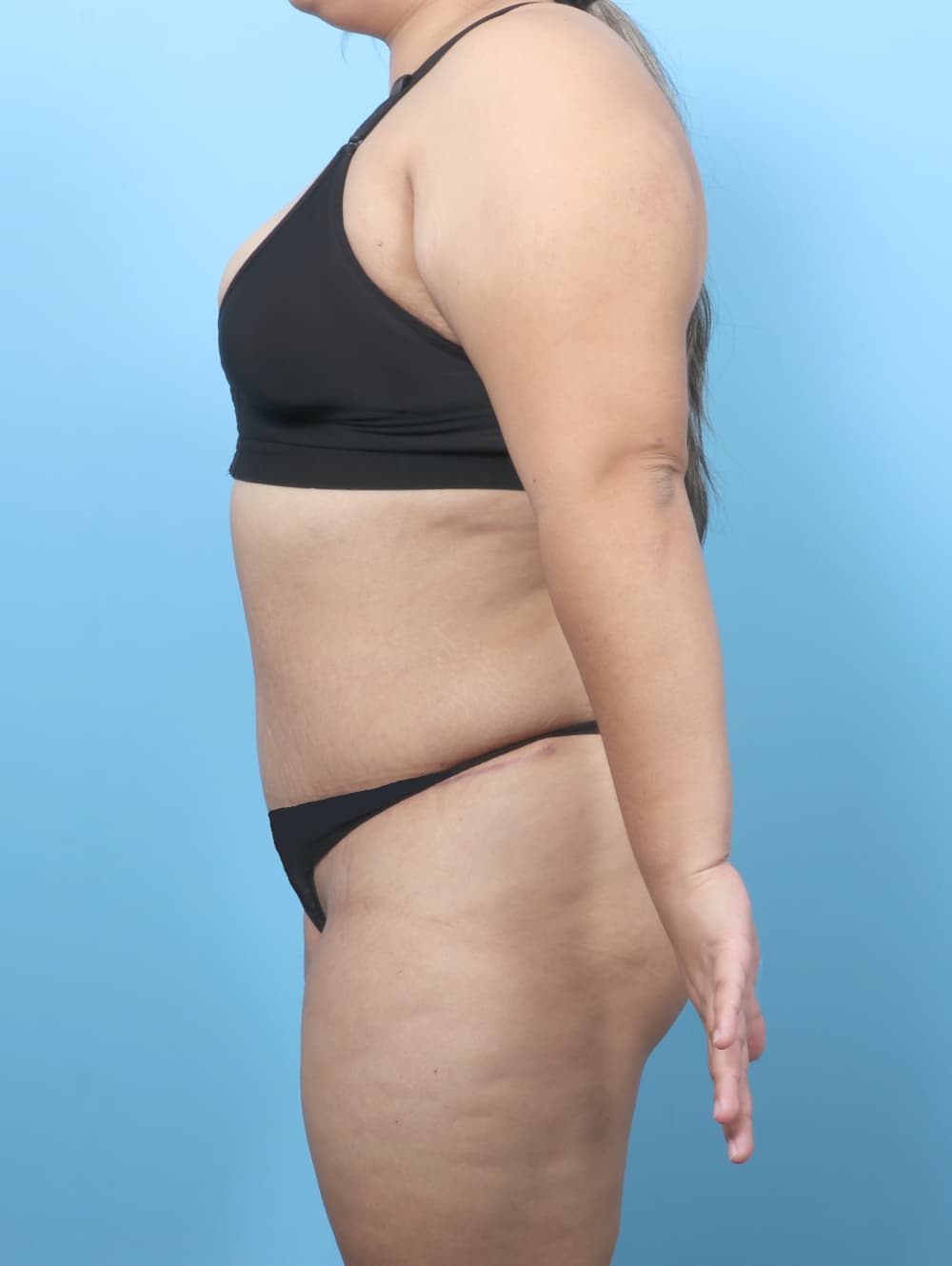 Tummy Tuck case #8738 after, image 3