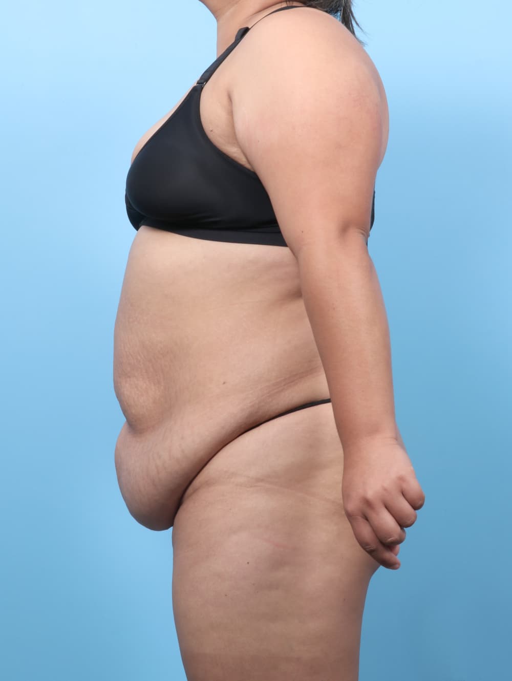 Tummy Tuck case #8738 before, image 3