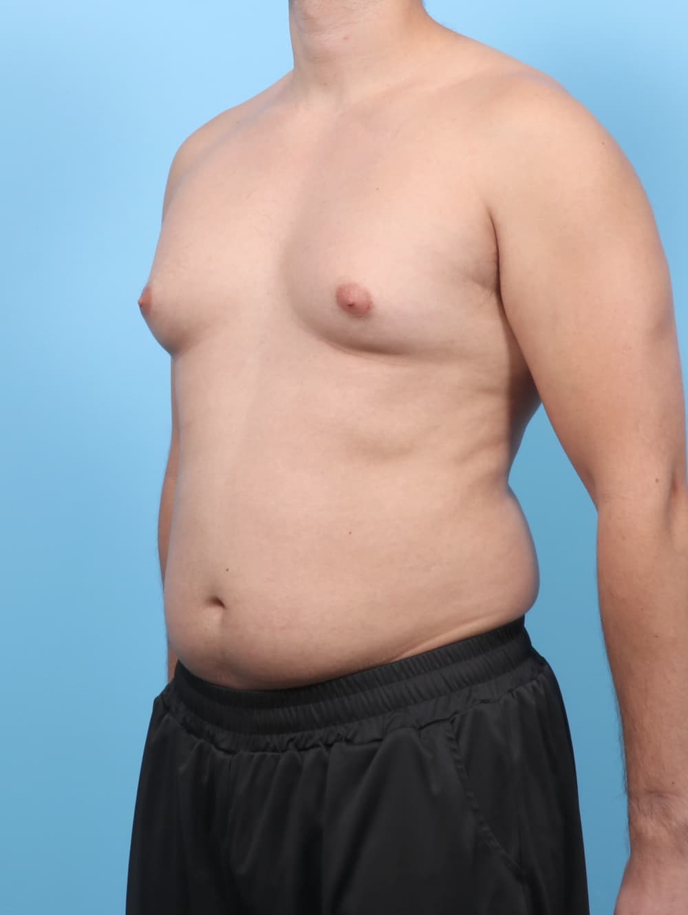 Male Breast Reduction case #7990 before, image 2