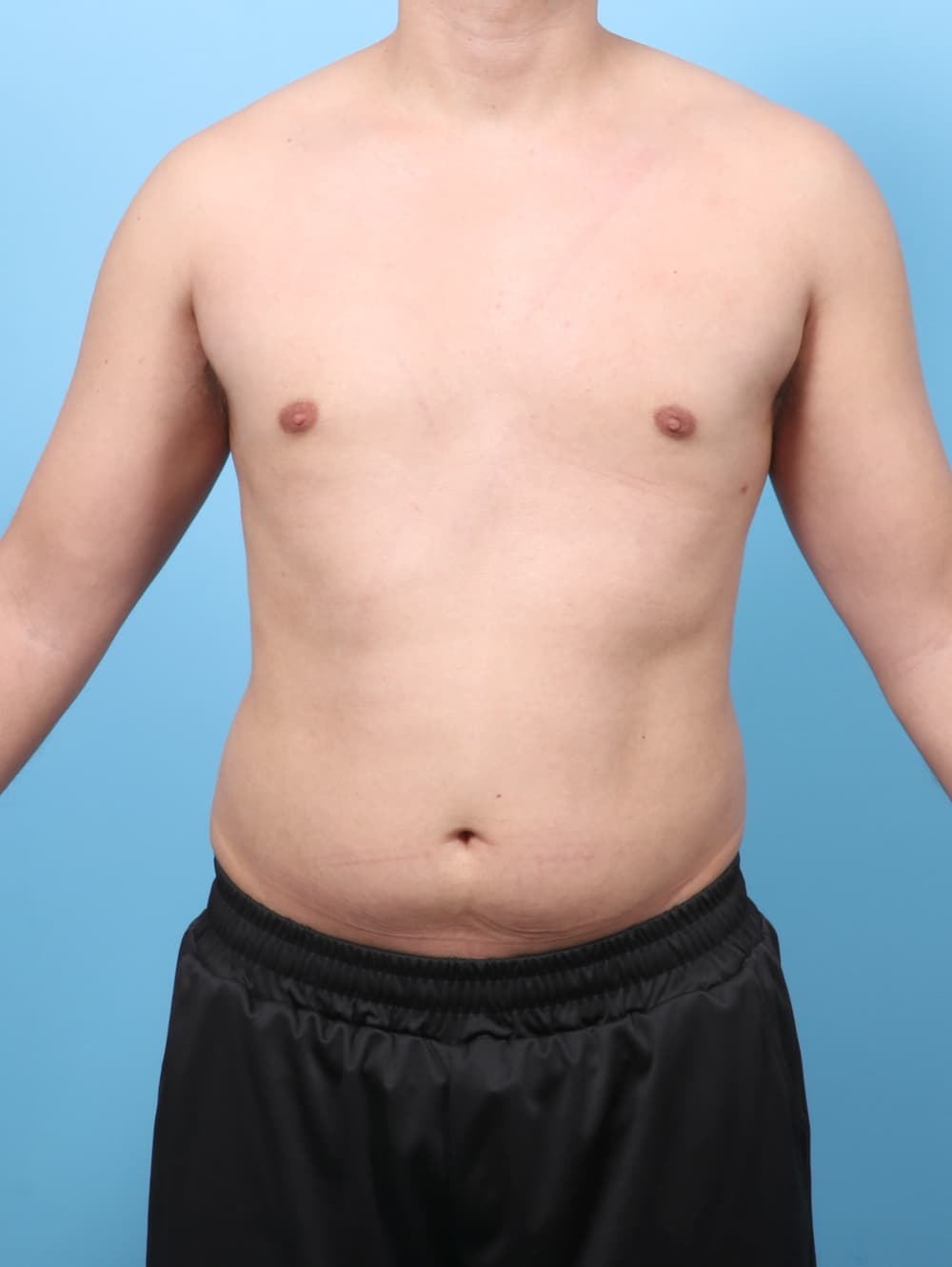 Body Contouring case #7990 after