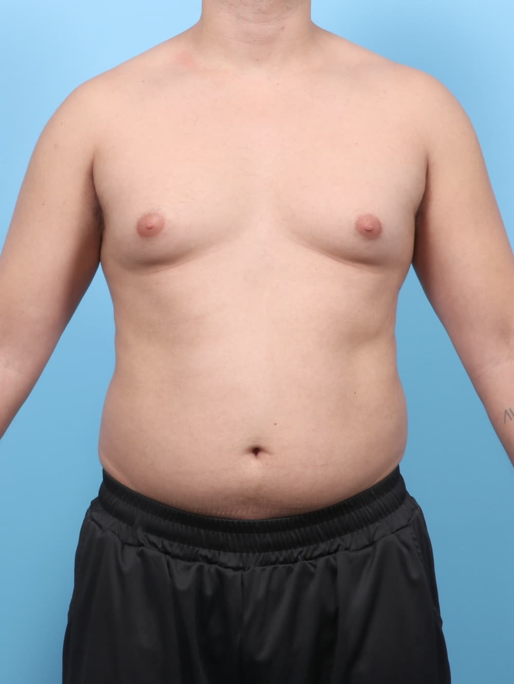 Body Contouring case #7990 before