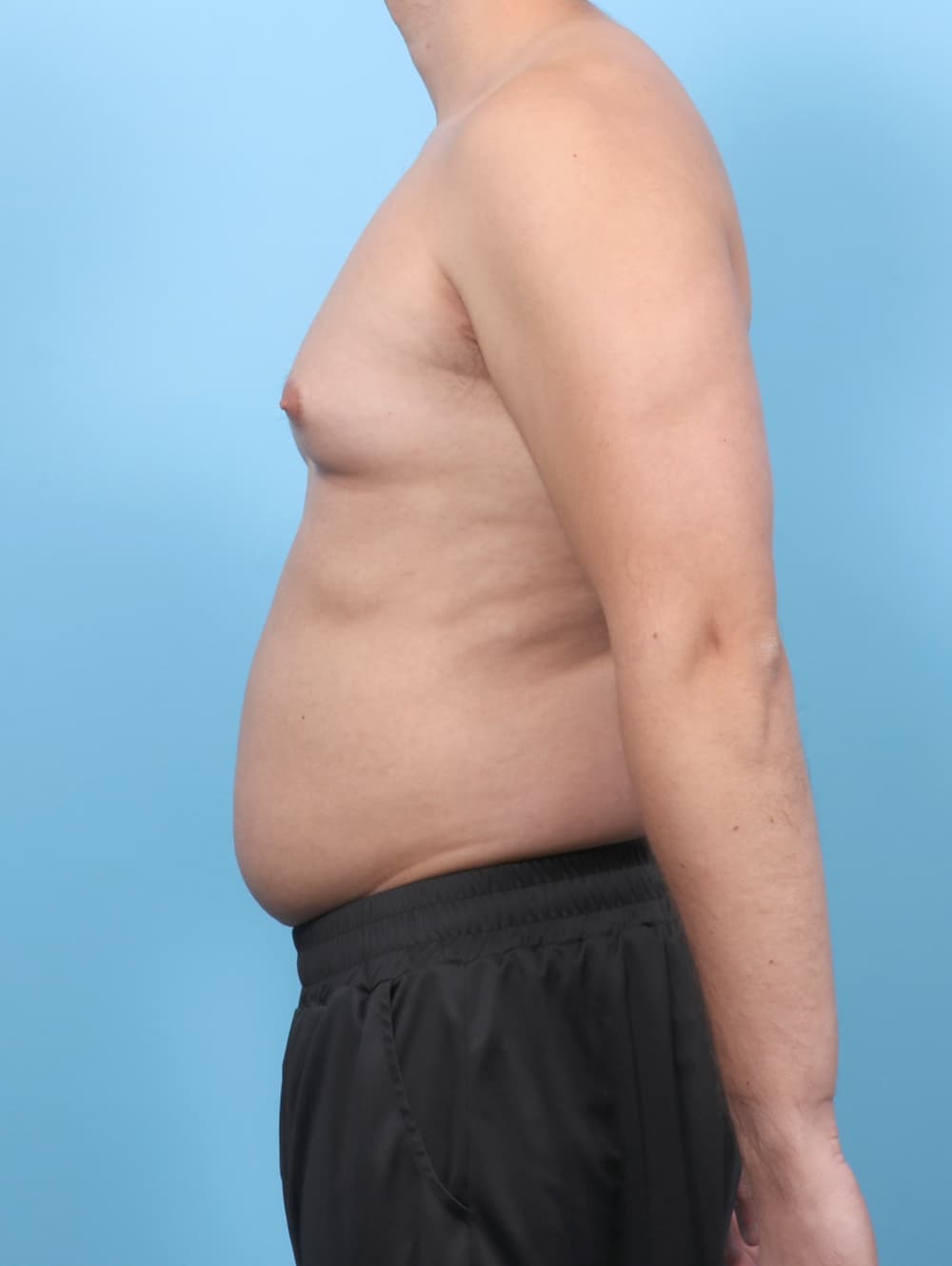 Male Breast Reduction case #7990 before, image 3