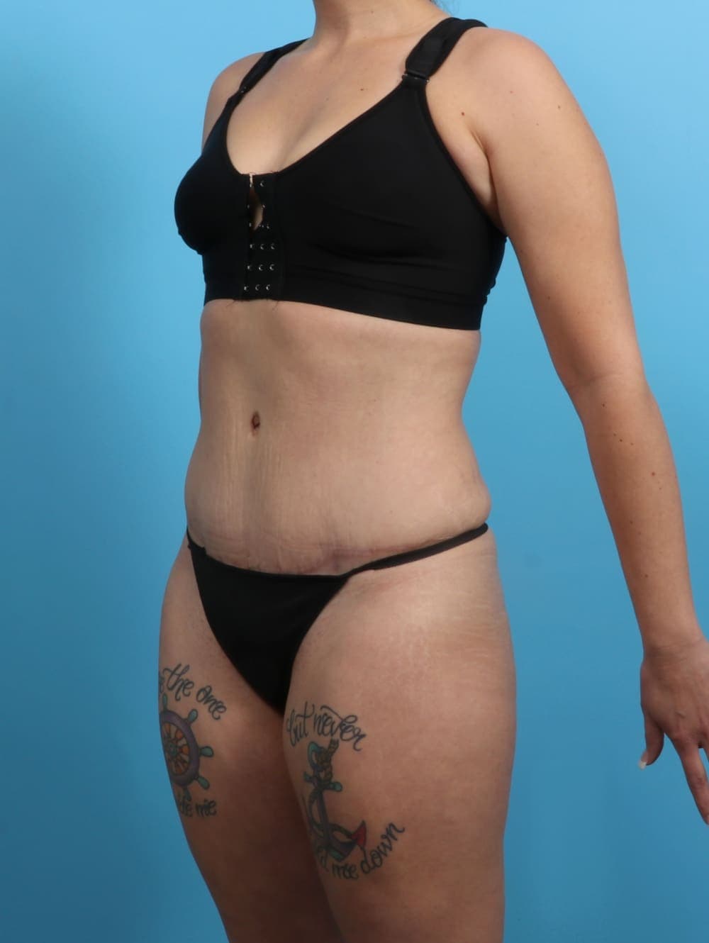 Liposuction case #3193 after, image 3