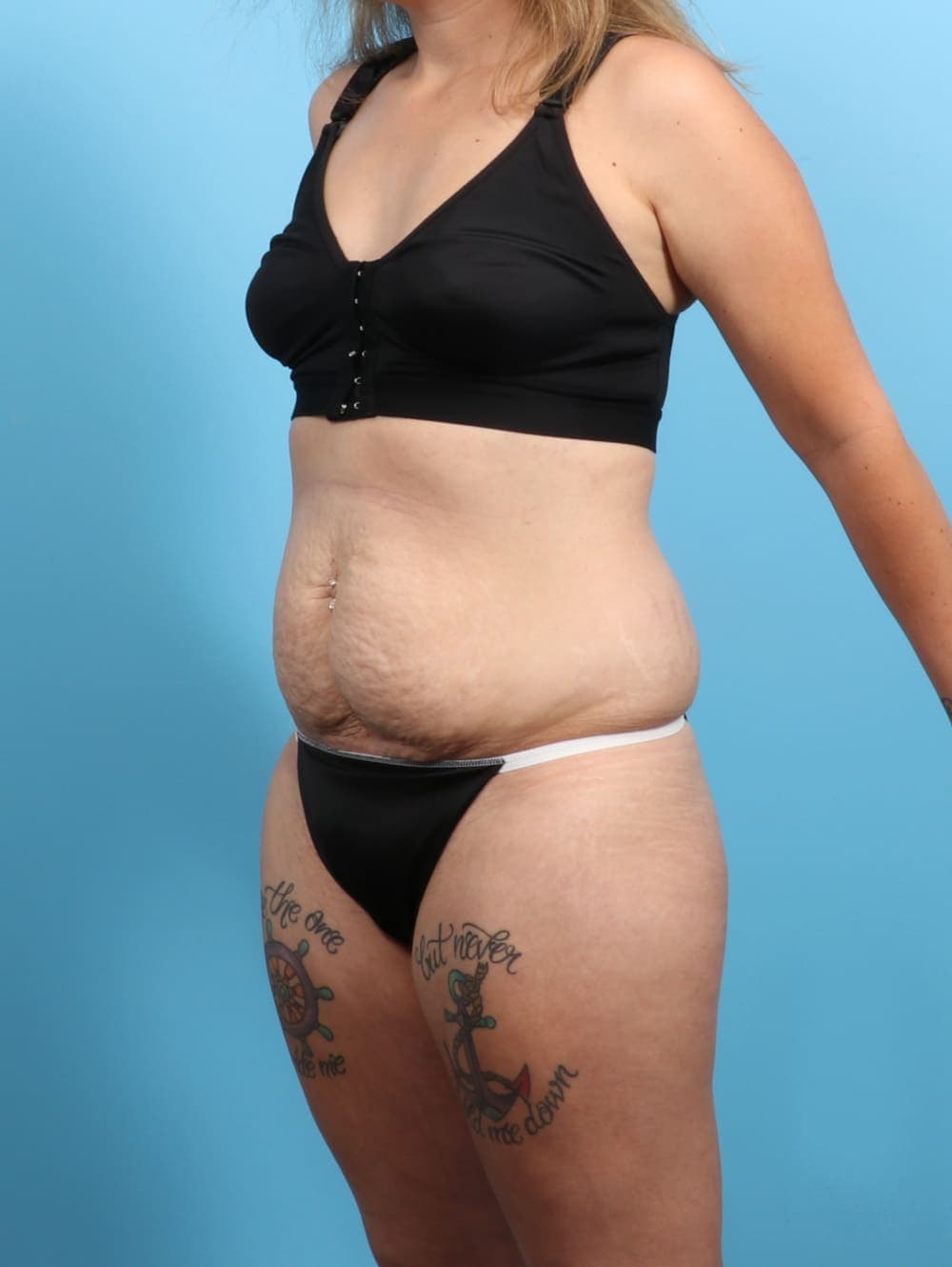 Liposuction case #3193 before, image 3
