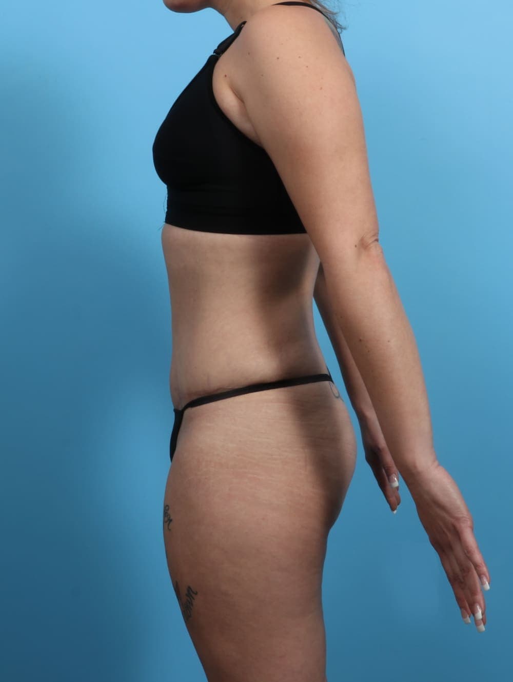 Liposuction case #3193 after, image 4