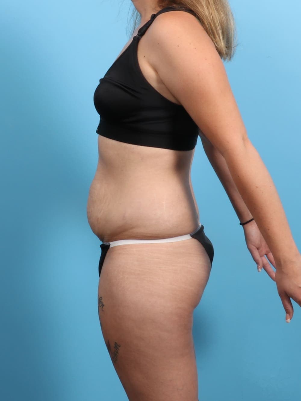 Liposuction case #3193 before, image 4