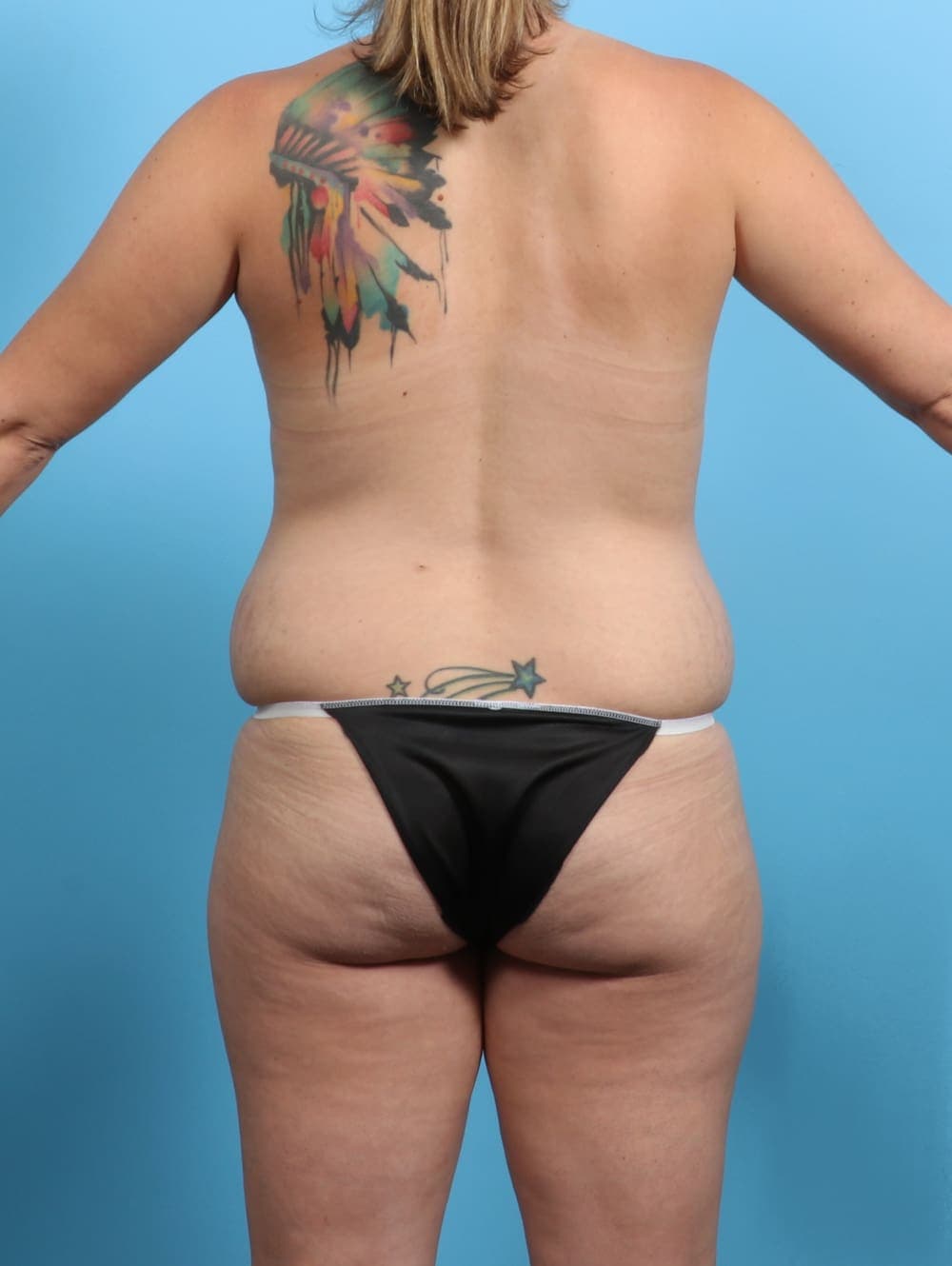 Liposuction case #3193 before, image 2