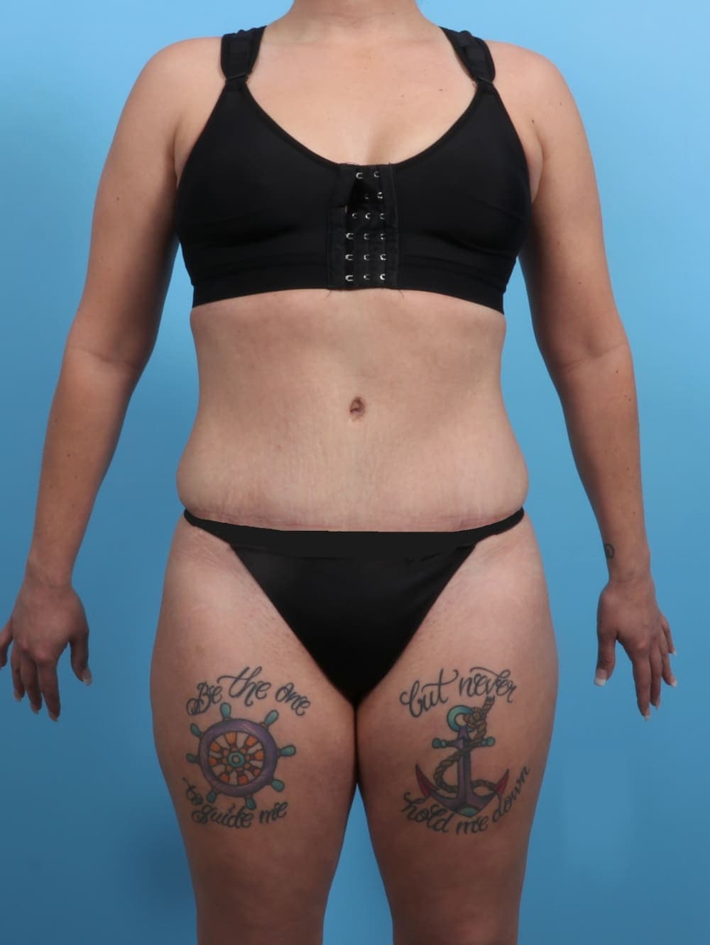 Liposuction case #3193 after