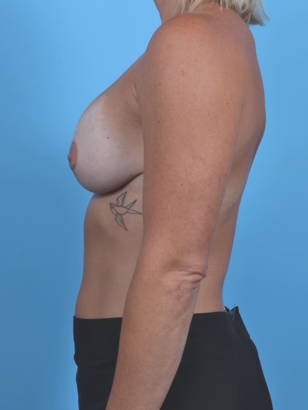 Breast Lift with Implants case #4027 after, image 3