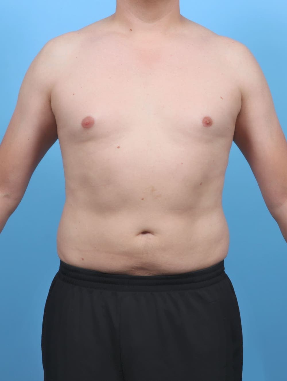 Liposuction case #5992 after