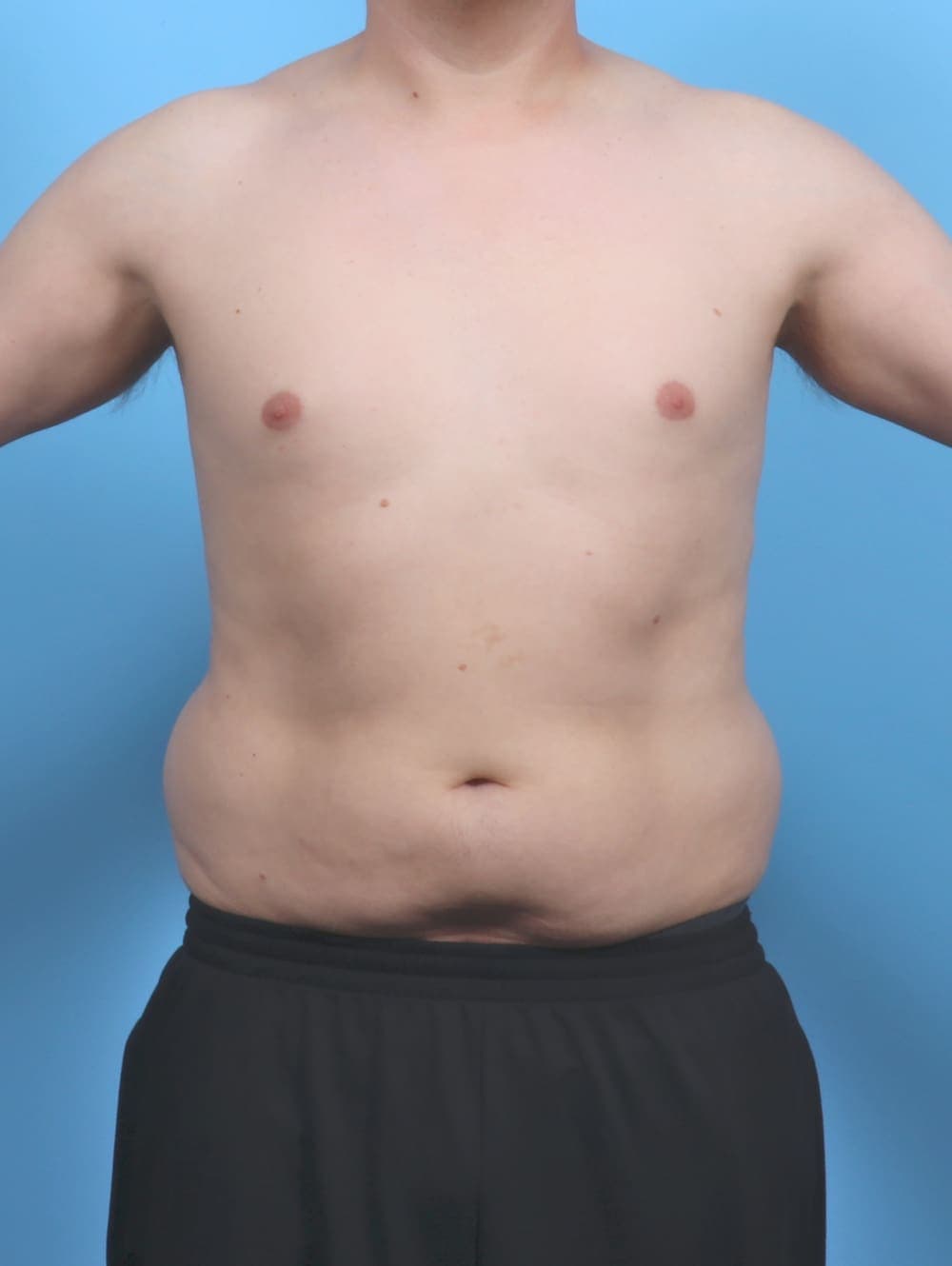 Liposuction case #5992 before