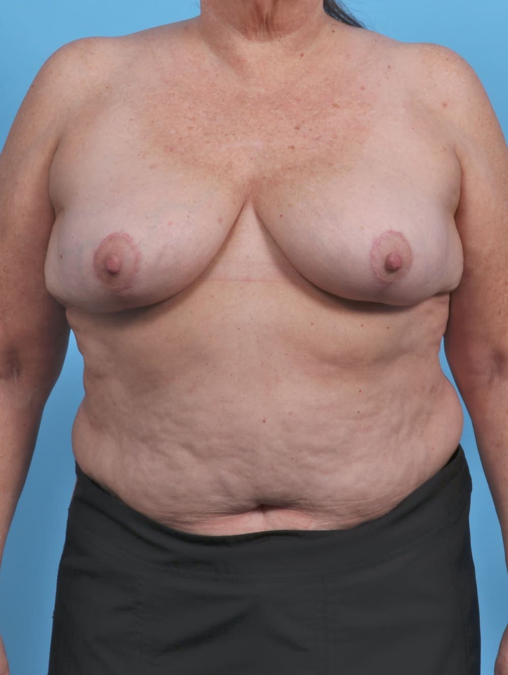 Breast Implant Revision case #4403 after
