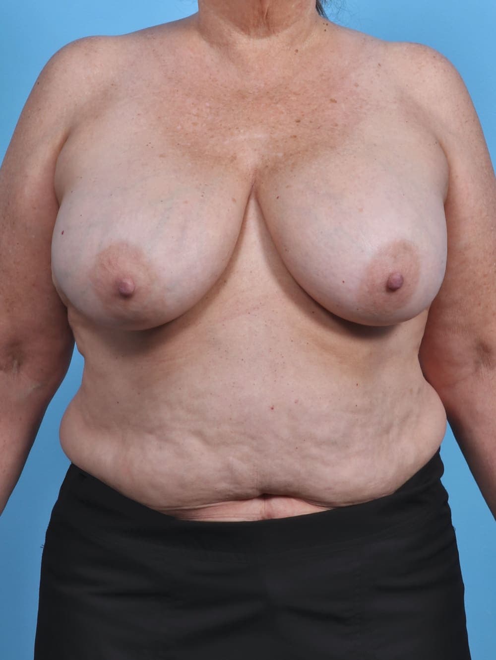 Breast Implant Revision case #4403 before
