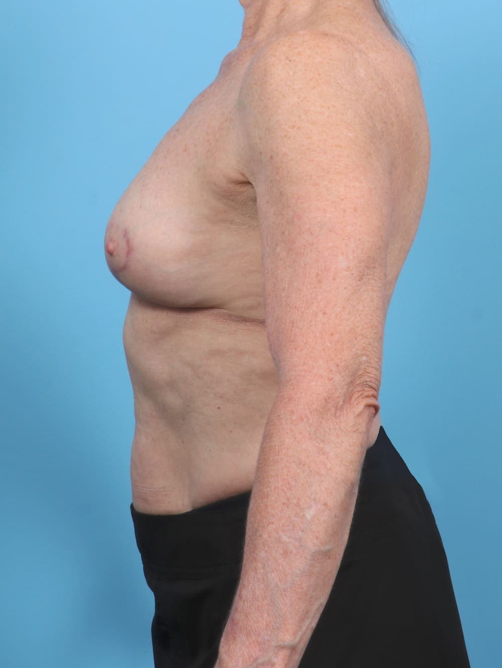 Breast Implant Removal with Lift case #5686 after, image 3