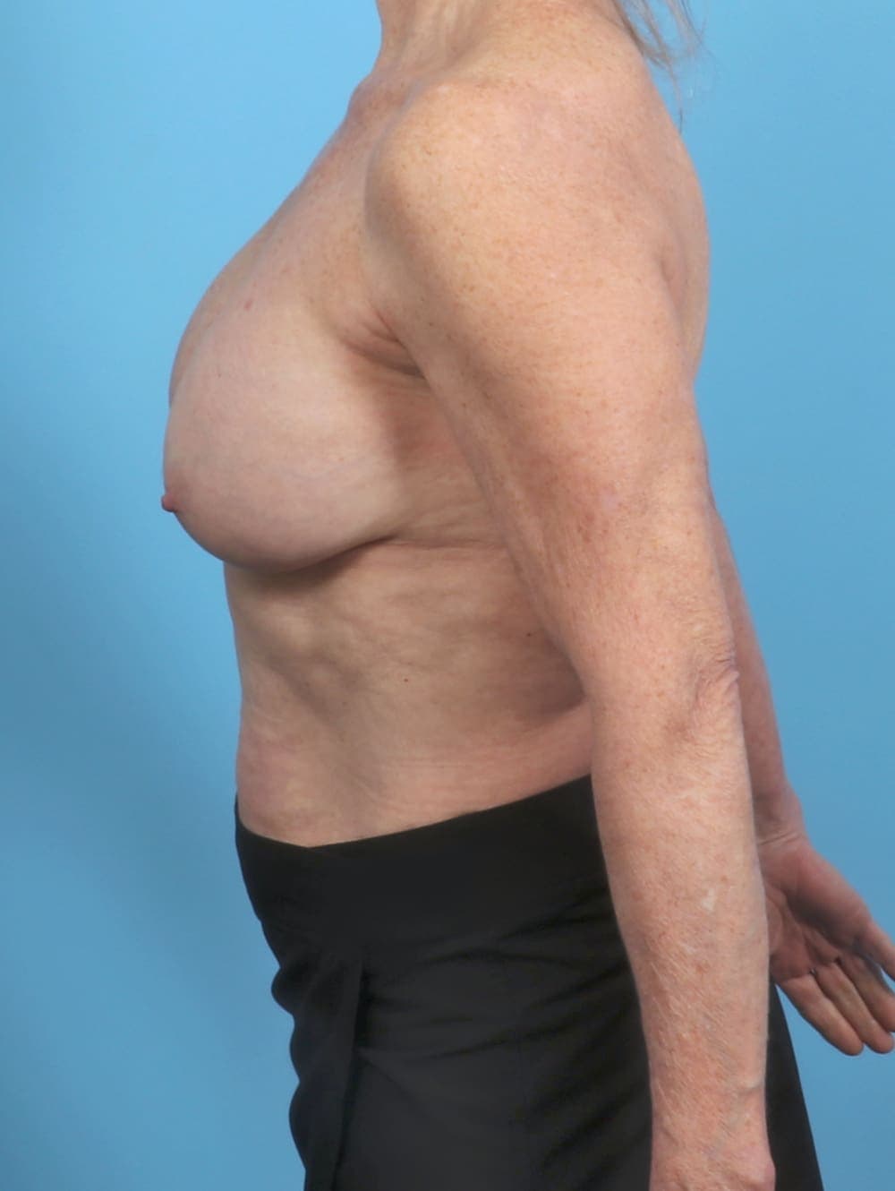 Breast Implant Removal with Lift case #5686 before, image 3