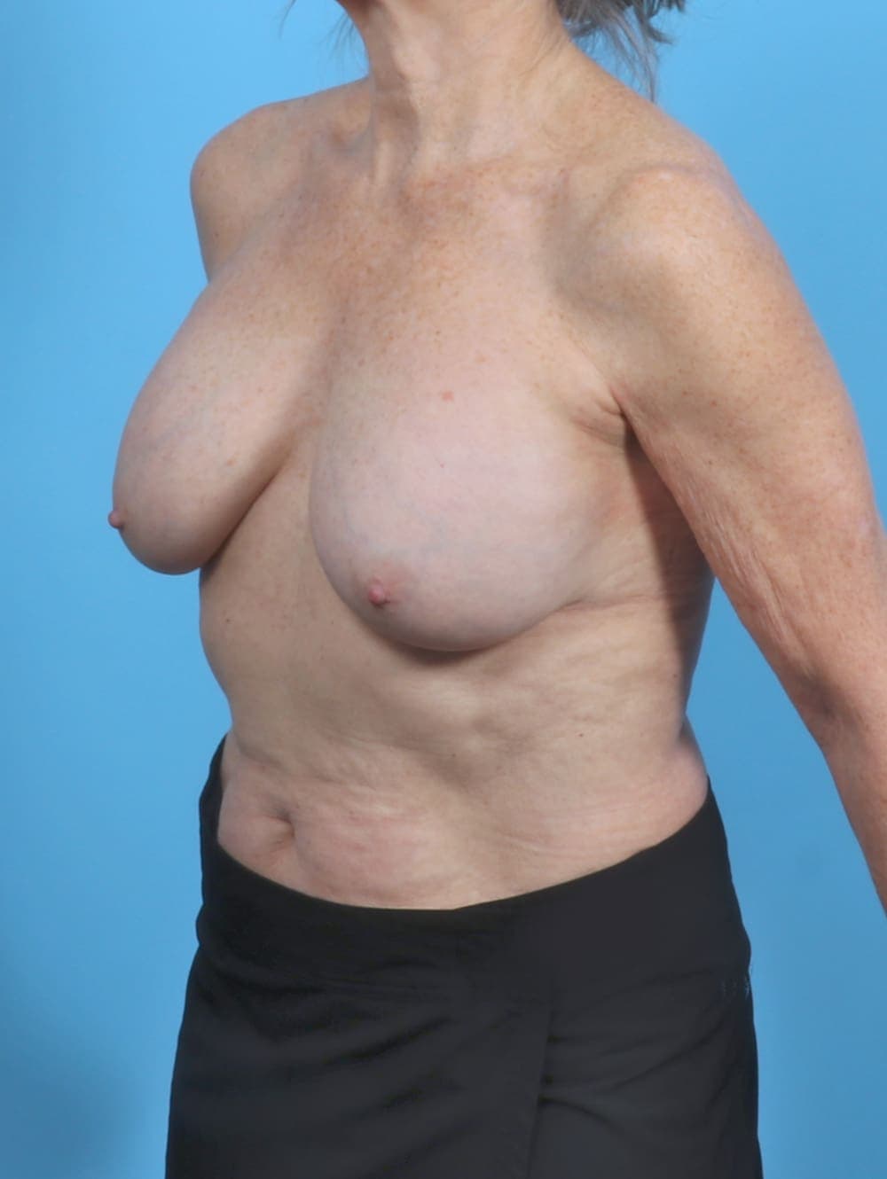 Breast Implant Removal with Lift case #5686 before, image 2