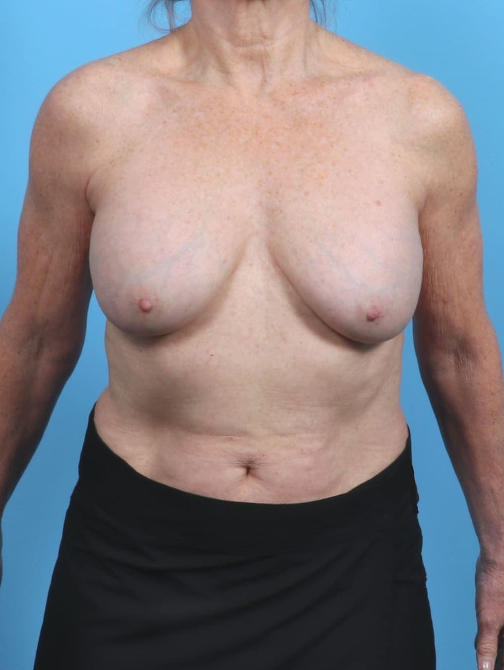 Breast Implant Removal with Lift case #5686 before, image 1