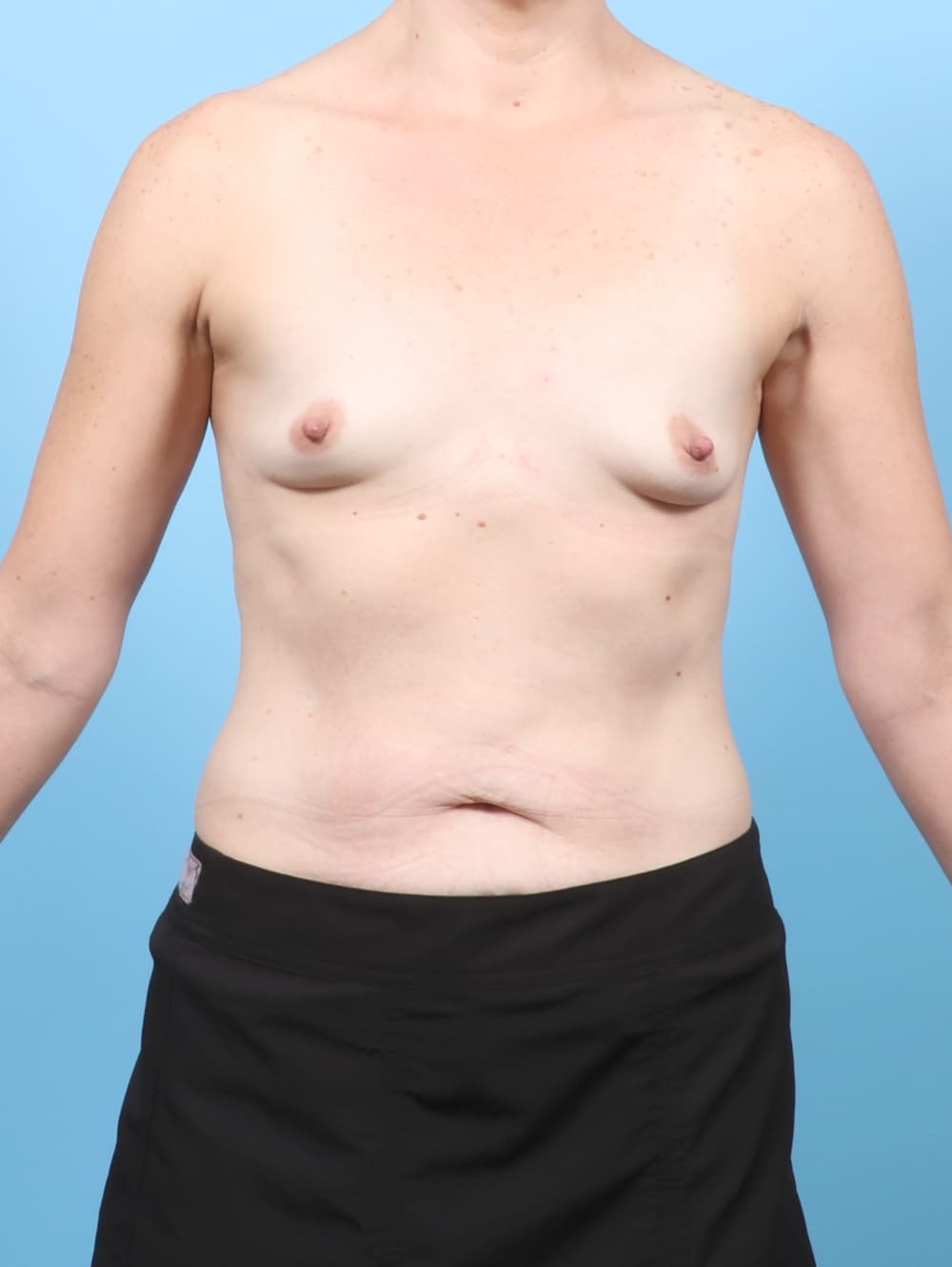 Breast Enhancement case #8626 before